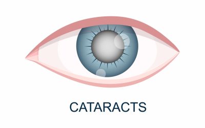 Cataratas en los ojos: causas síntomas y tratamientos para prevenir la pérdida de visión